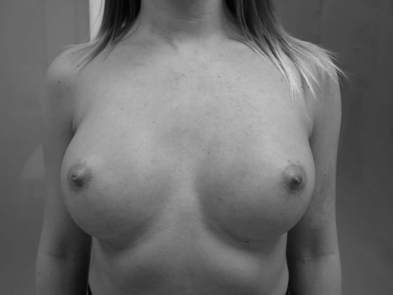 Brustvergrößerung nach der Operation