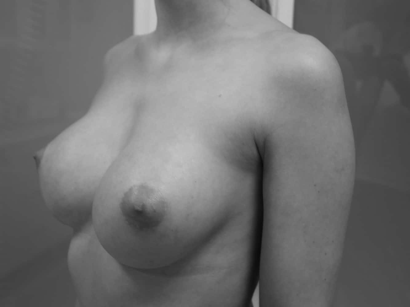 Brustvergrößerung nach der Operation